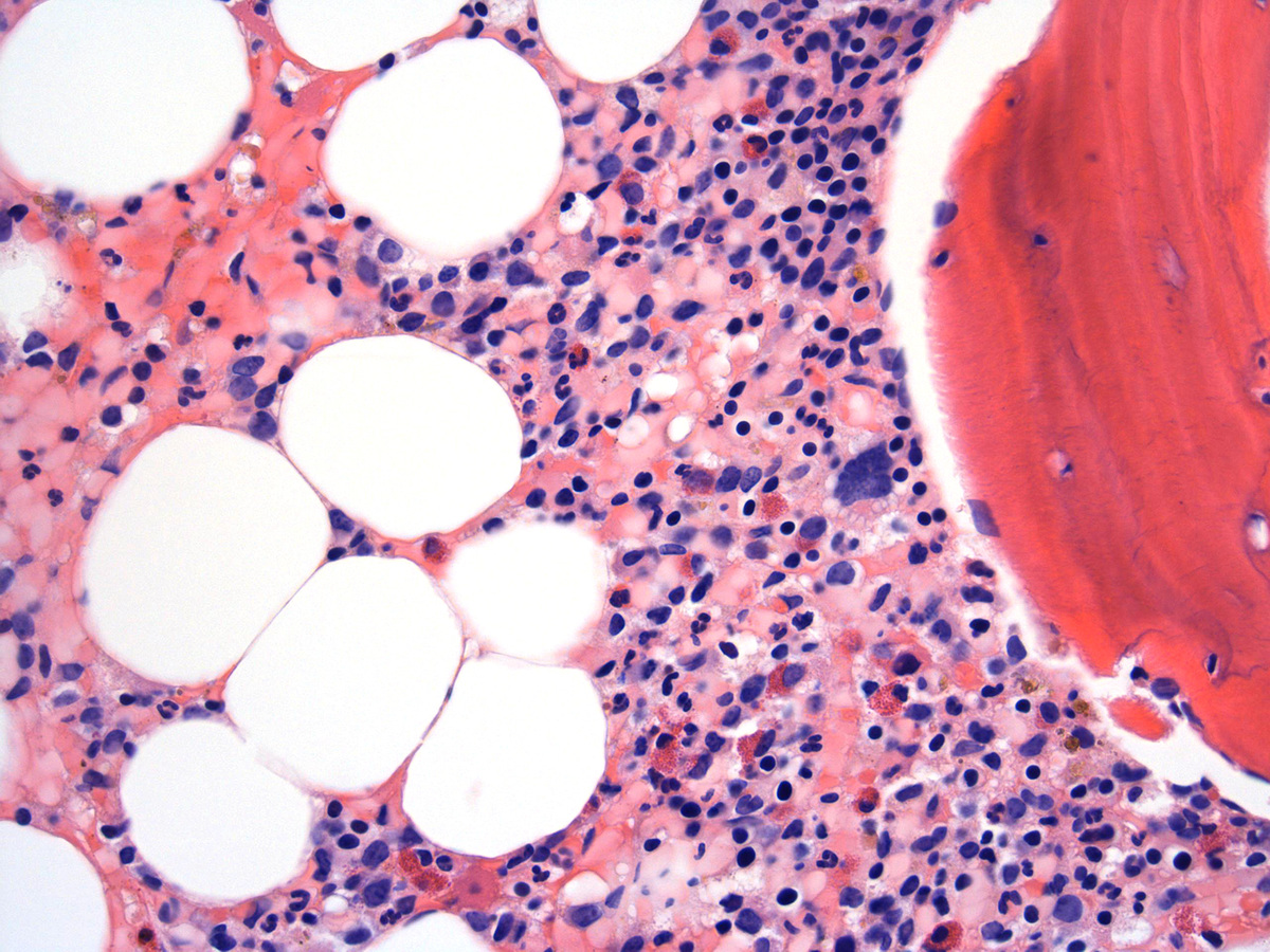 Bone Marrow biopsy_3
